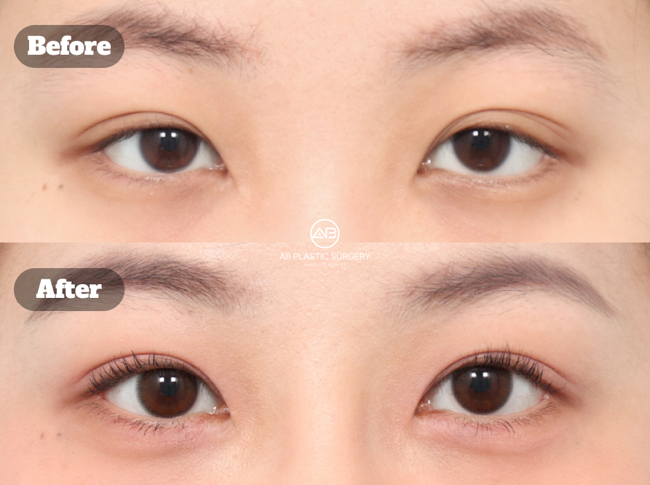 Perbandingan mata sebelum dan sesudah koreksi ptosis tanpa sayatan dengan epikantoplasti untuk tampilan mata yang lebih terbuka.