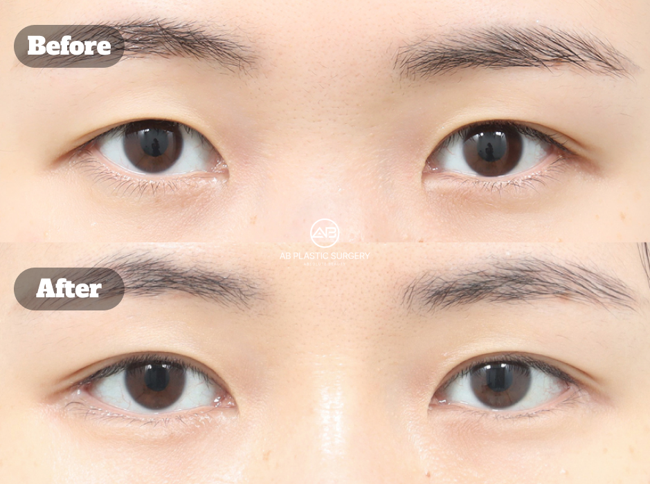 Hasil sebelum dan sesudah revisi kelopak mata dengan kantoplasti lateral dan bawah untuk memperbaiki bentuk sudut mata.
