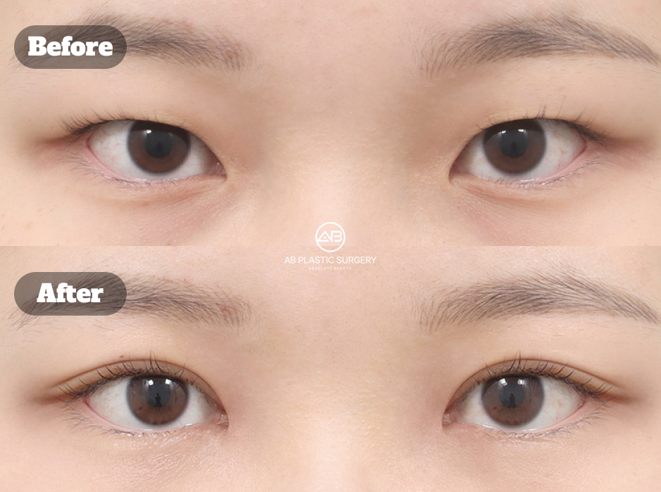 Close-up before-and-after comparison showing changes after incisional ptosis correction combined with medial epicanthoplasty.