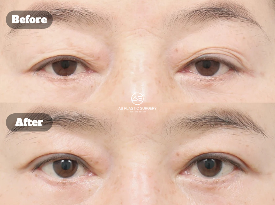 Perbandingan kondisi kelopak mata sebelum dan dua bulan setelah upper blepharoplasty dengan lipatan mata yang tampak lebih jelas.