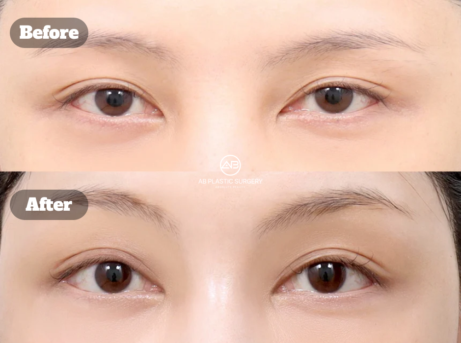 Foto sebelum dan satu bulan sesudah Endotine brow lift yang membantu mengangkat posisi alis dan area kelopak mata atas.