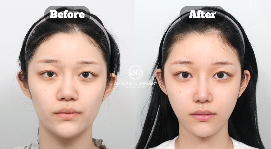 Front-view before-and-after images showing a more balanced nasal shape and facial proportions following revision rhinoplasty in Korea.