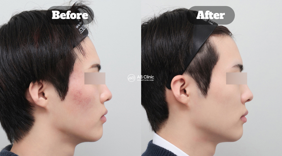 Side-profile before-and-after comparison showing reduced cheek redness and improved skin appearance one month after Potenza and Juvelook treatment.