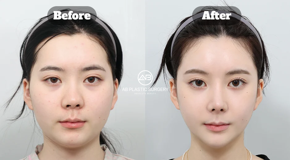 Front-view comparison showing facial contour changes after square jaw reduction and chin contouring surgery in Korea.