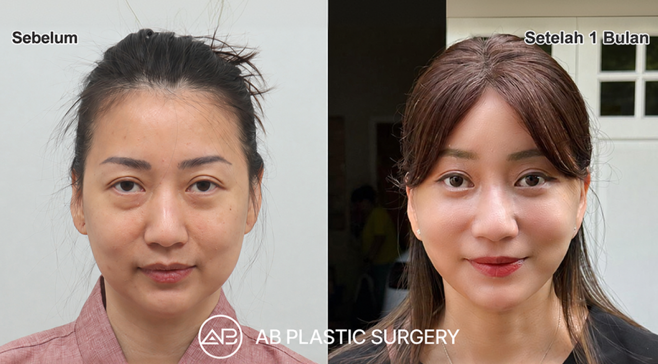Before-and-after comparison of Indonesian influencer Nana Koot one month after a full SMAS facelift and personalized facial procedures in Korea.