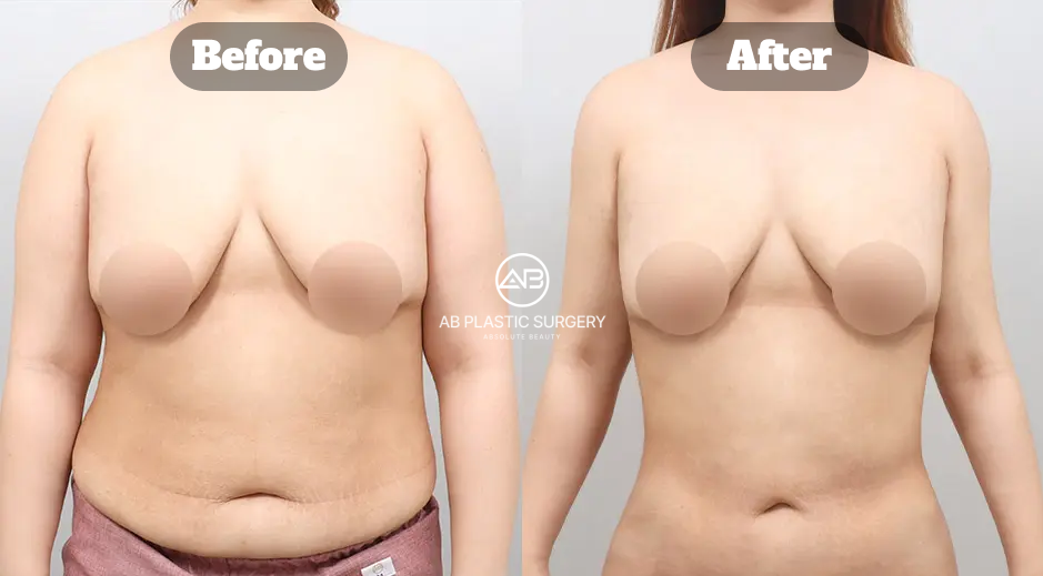 Sebelum dan Sesudah Sedot Lemak Lengan, Perut, dan Pinggang yang Menunjukkan Perubahan Proporsi Tubuh Bagian Atas dan Torso