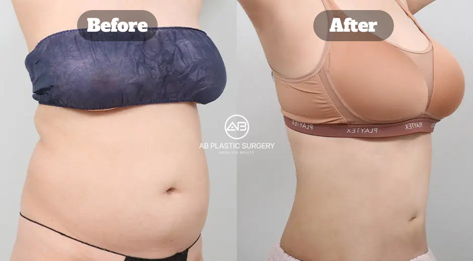 Perbandingan Sebelum dan Sesudah Body Contouring dengan Sedot Lemak Lengan, Perut, dan Pinggang untuk Membentuk Proporsi Tubuh
