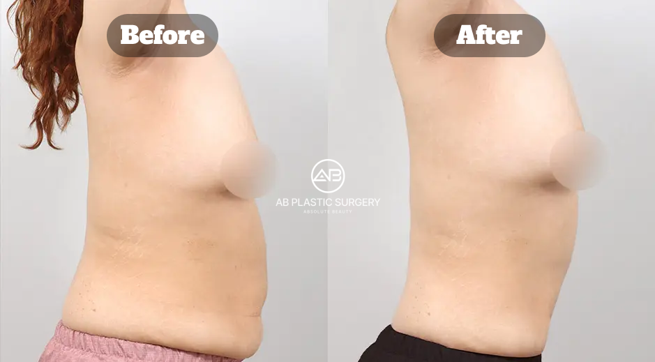 Hasil Sebelum dan Sesudah Liposuction pada Lengan, Punggung Atas, Perut, dan Pinggang untuk Memperbaiki Kontur Tubuh Secara Menyeluruh