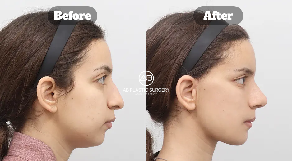 Foto perbandingan profil sebelum dan sesudah operasi hidung tanpa implan di Korea