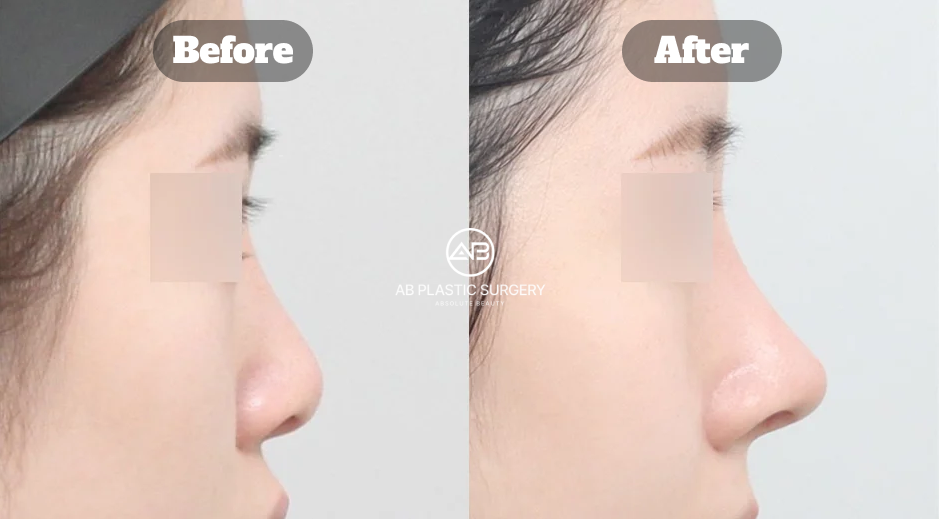 Foto profil sebelum dan sesudah operasi koreksi hidung pendek dengan perubahan panjang dan ujung hidung