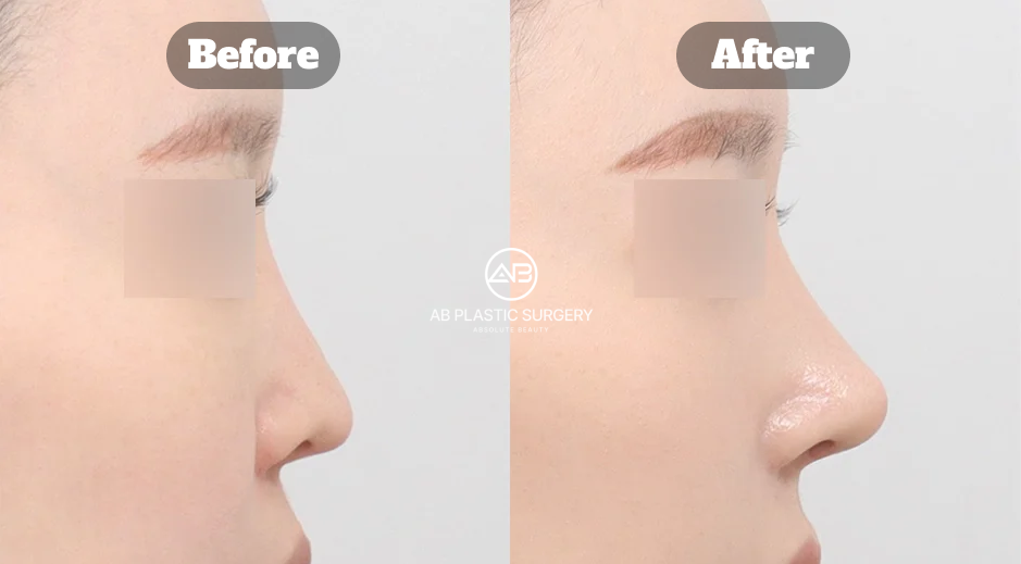 Foto profil sebelum dan sesudah operasi revisi hidung yang menunjukkan penyesuaian garis batang dan ujung hidung