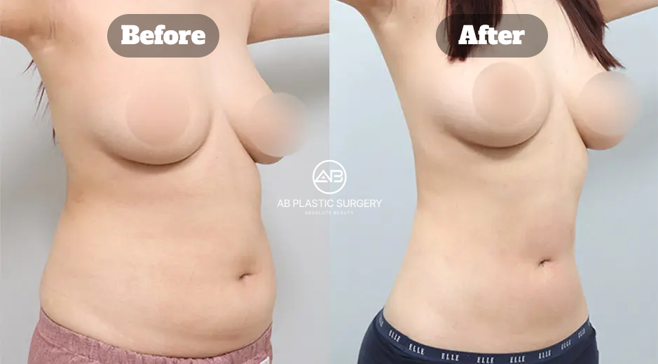 Hasil Sebelum dan Sesudah Sedot Lemak Perut dan Pinggang untuk Membentuk Garis Torso yang Lebih Proporsional
