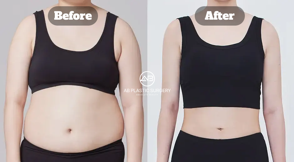 Perbandingan Sebelum dan Sesudah Liposuction pada Perut dan Sisi Pinggang untuk Memperbaiki Kontur Tubuh