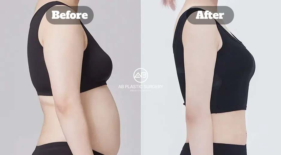 Tampak Samping Sebelum dan Sesudah Liposuction Perut dan Pinggang dengan Perubahan pada Garis Perut dan Pinggang