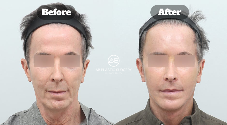 Dua foto frontal pria dengan mata disamarkan, Before di kiri dan After di kanan, menampilkan perubahan kulit wajah kendur setelah prosedur lifting; logo AB berada di antara kedua foto dan gambar ini merupakan contoh kasus perawatan gabungan, bukan hasil dari satu prosedur saja.