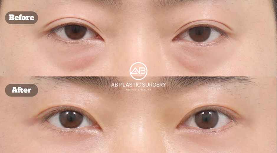 Dua foto tampak depan area mata disusun vertikal, dengan label Before di atas dan After di bawah serta logo AB di tengah. Kasus sumber mencakup reposisi lemak bawah mata, pencangkokan lemak bawah mata, dan koreksi ptosis insisional.