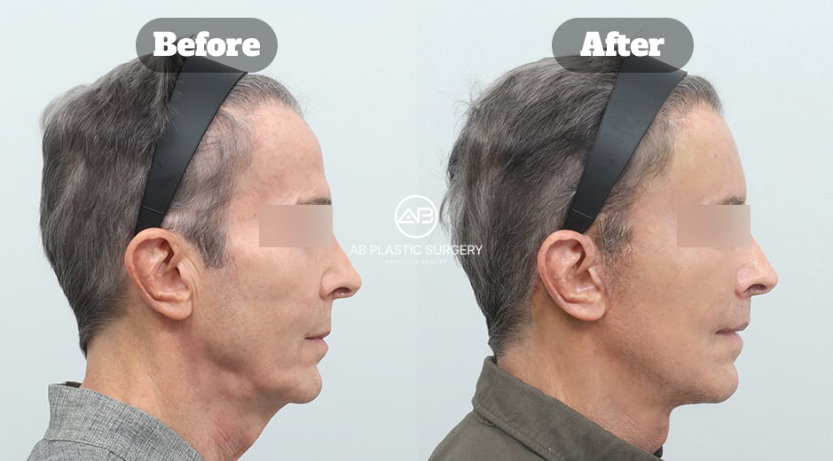 Dua foto profil kanan pria yang sama dengan gambar H2 pertama, dengan mata disamarkan, Before di kiri dan After di kanan; rahang, bawah dagu, dan leher terlihat.