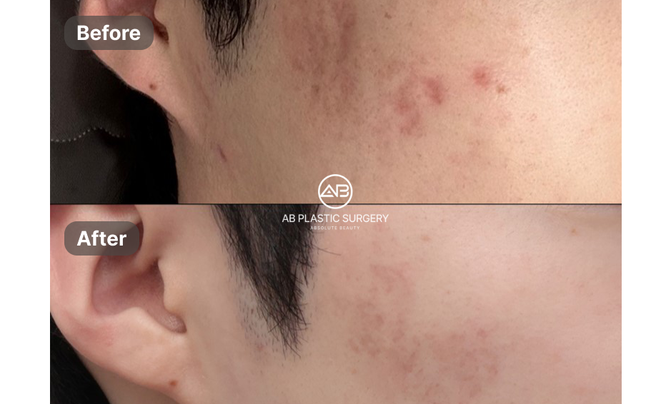 Dua foto dekat pipi disusun vertikal, dengan label Before di atas dan After di bawah. Tekstur kulit dan tanda kemerahan terlihat pada pipi; logo AB PLASTIC SURGERY berada di tengah.