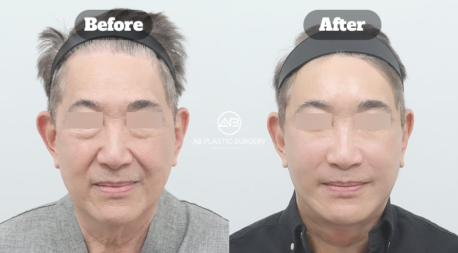 Dua foto frontal pria berambut abu-abu dengan mata disamarkan, Before di kiri dan After di kanan; logo AB berada di tengah, dengan pipi, garis rahang, serta leher terlihat.