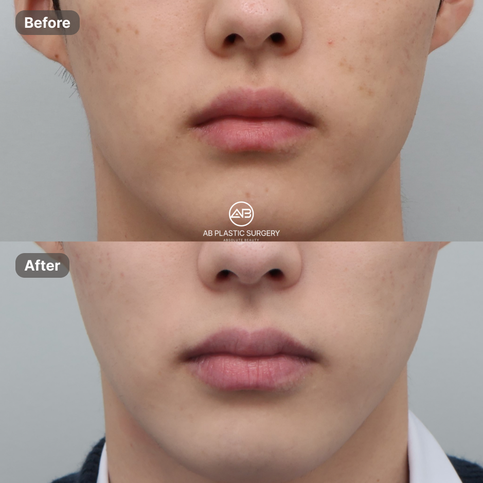 Dua foto frontal bagian bawah wajah, termasuk pipi, bibir, dan dagu, disusun vertikal. Before berada di atas dan After di bawah; logo AB PLASTIC SURGERY berada di tengah.