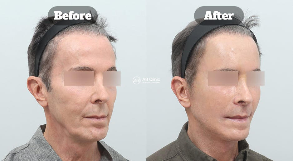 Dua foto pria dari sudut miring dengan mata disamarkan, Before di kiri dan After di kanan serta logo AB di tengah; merupakan sudut lain dari kasus gabungan pada gambar H2 pertama.