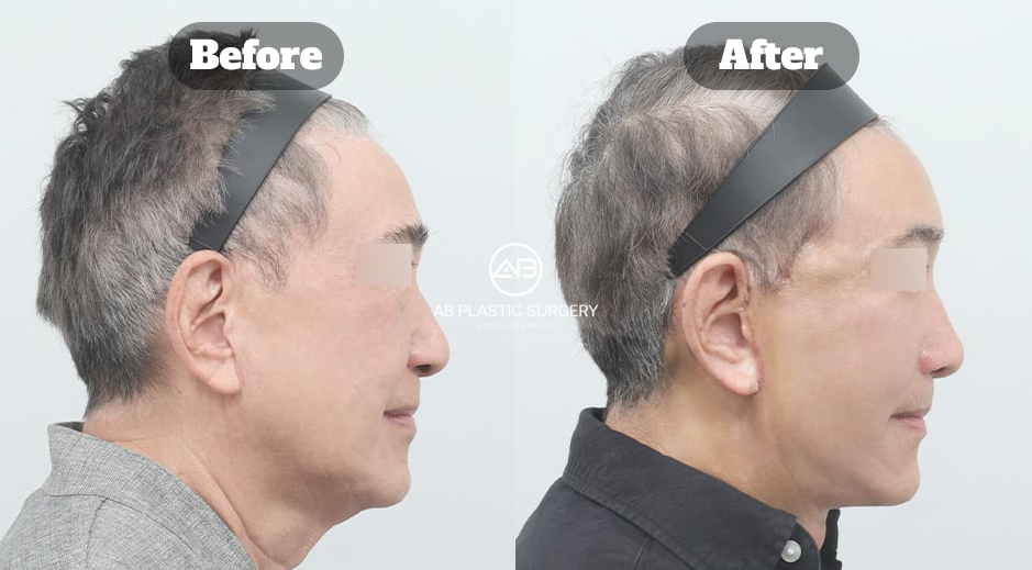 Dua foto profil kanan pria berambut abu-abu, Before di kiri dan After di kanan dengan logo AB di tengah; merupakan sudut lain dari kasus pada gambar H2 ketiga, tanpa tanggal pemotretan yang tercetak.