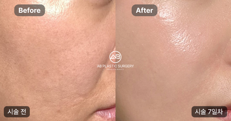 Dua foto dekat pipi dan sisi hidung diletakkan berdampingan dengan label Before di kiri dan After di kanan. Teks Korea di kanan menyebut tujuh hari setelah tindakan; logo AB PLASTIC SURGERY berada di tengah.