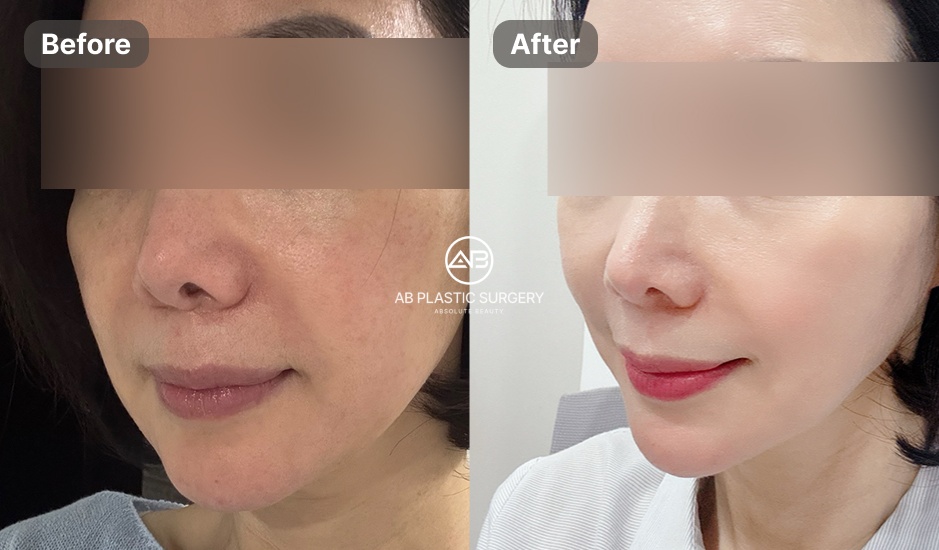 Foto wajah perempuan dari sudut miring ditampilkan berdampingan dengan label Before di kiri dan After di kanan. Kedua area mata ditutupi dan logo AB PLASTIC SURGERY berada di tengah.