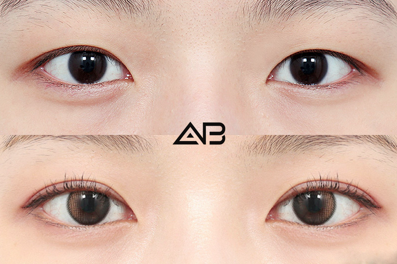 韓国の眼科手術であなたのルックを変身させる：総合ガイド | AB美容