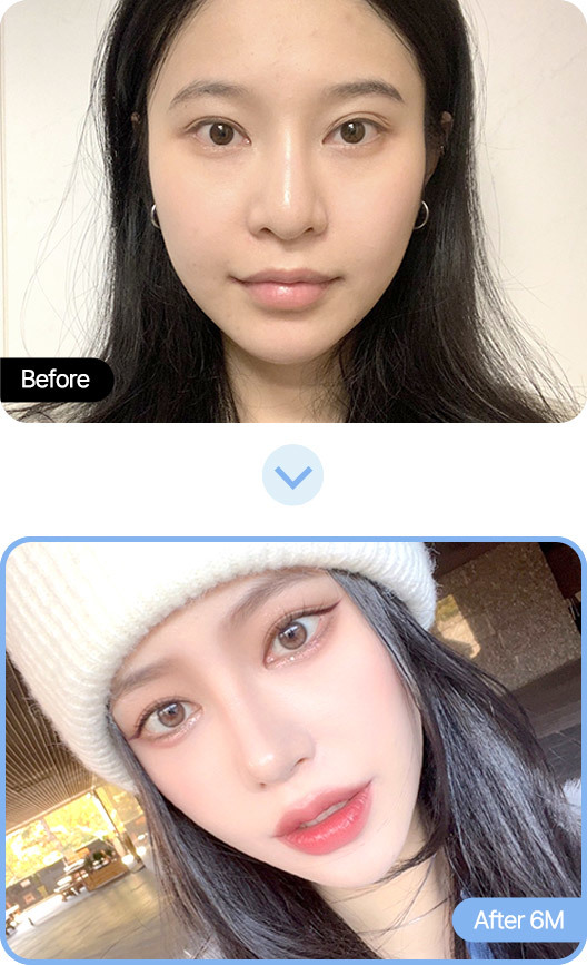 AB整形外科の実際のビフォーアフター写真