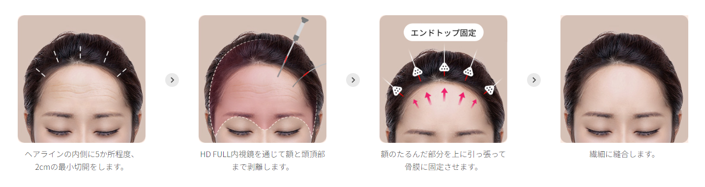 エンドタインインプラント額リフト