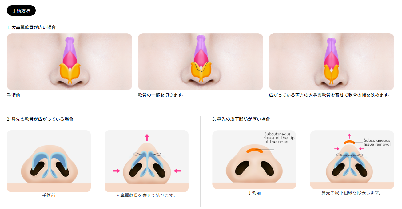 韓国でのだんご鼻整形手術