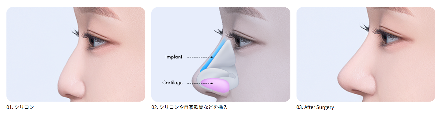 韓国でのフラットノーズ整形
