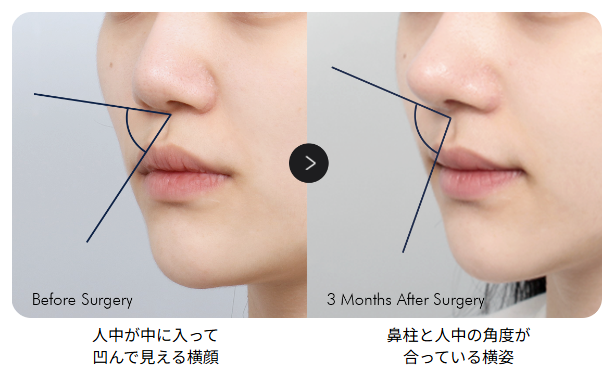 短い鼻の整形手術のビフォーアフター