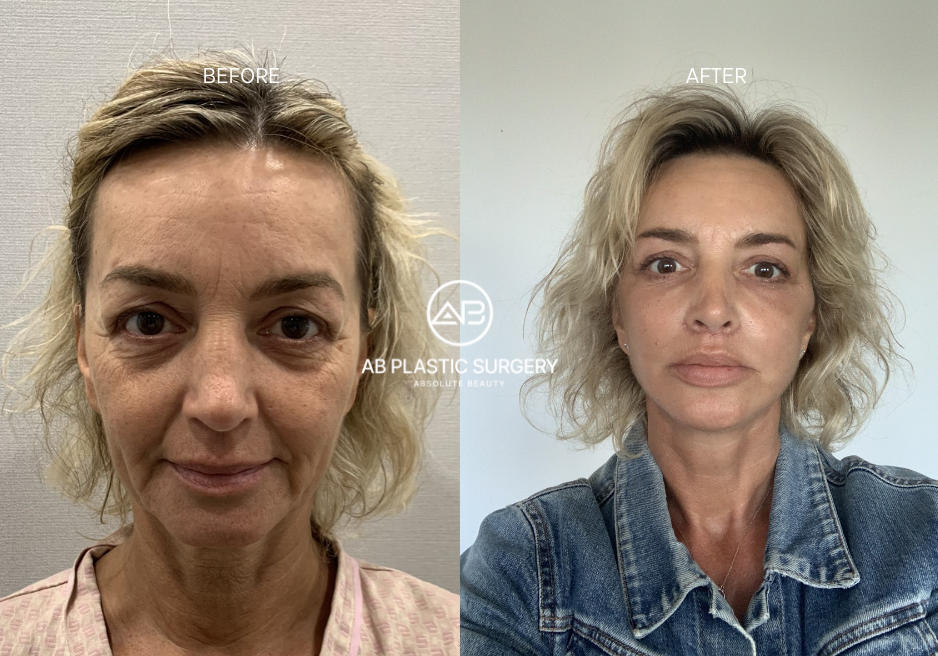 医療観光韓国 - カスタマイズされた整形手術