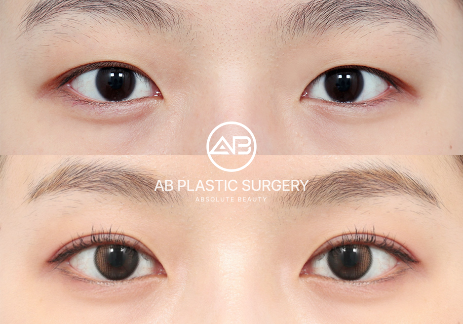 韓国目整形ビフォーアフター写真