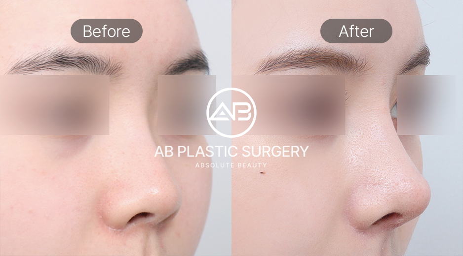 忘れ鼻を叶える低い鼻の整形で自然な変化