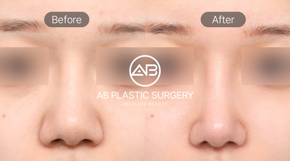 短い鼻整形のビフォーアフター写真