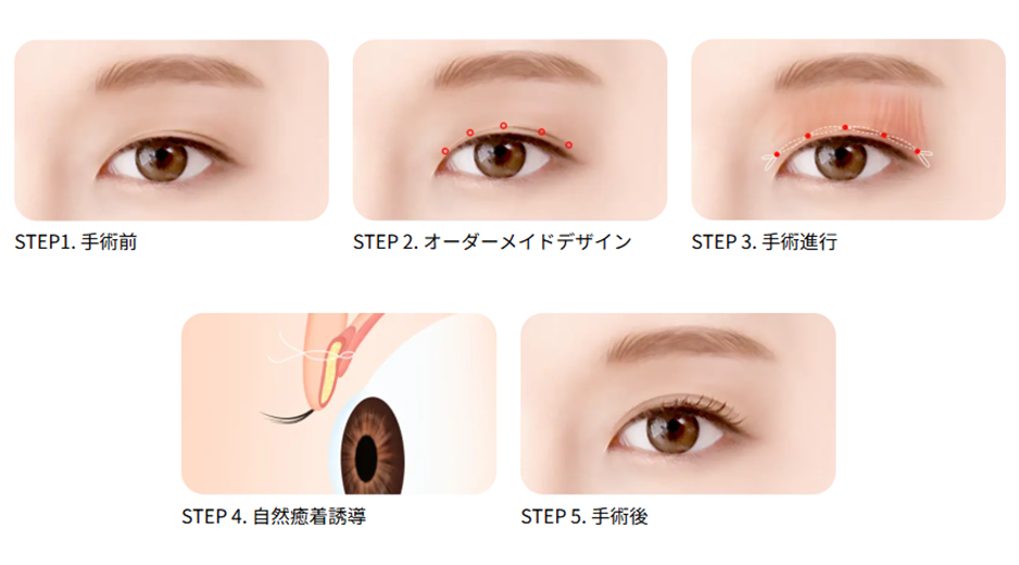 韓国の自然癒着二重術