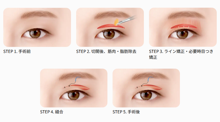 韓国の切開二重手術の過程