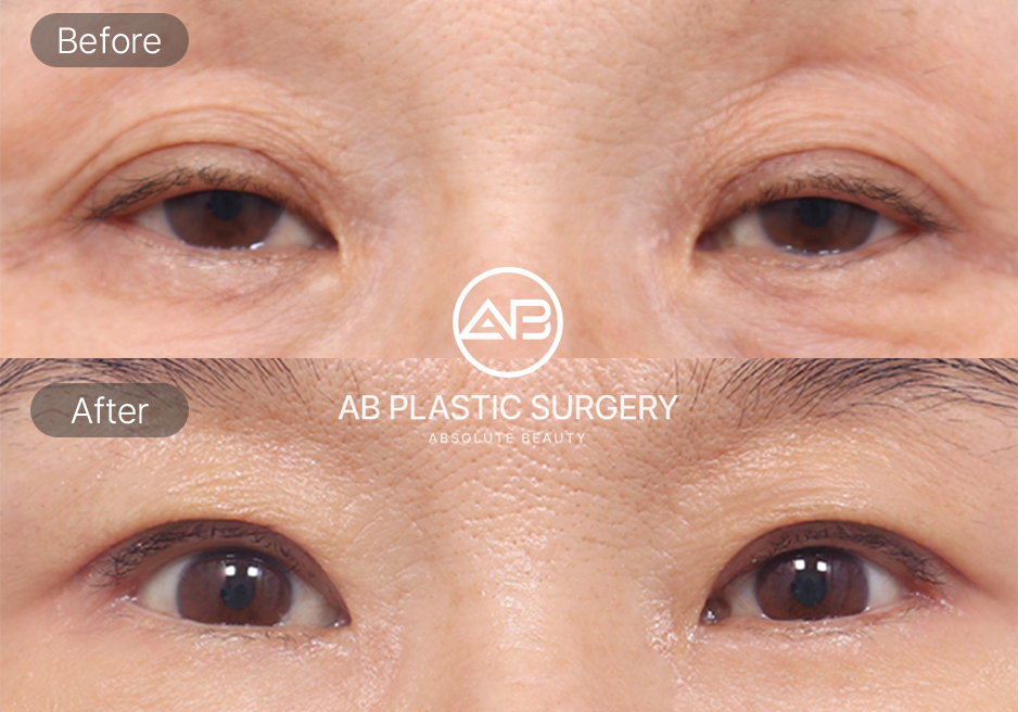 60代 上眼瞼手術のビフォーアフター写真