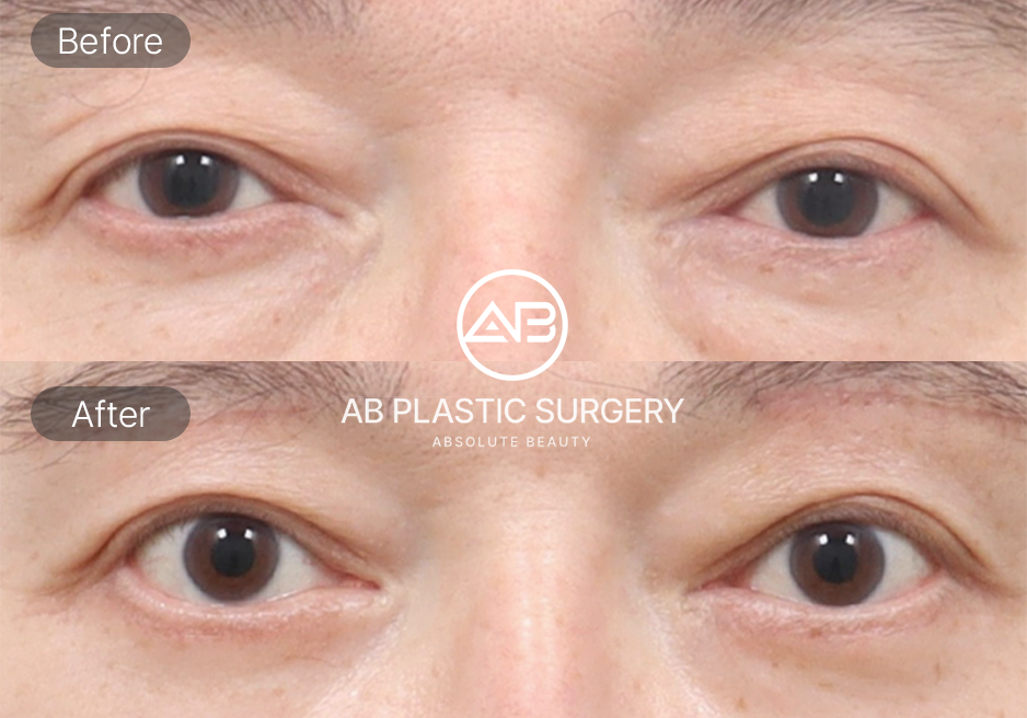 下眼瞼手術のビフォーアフター写真