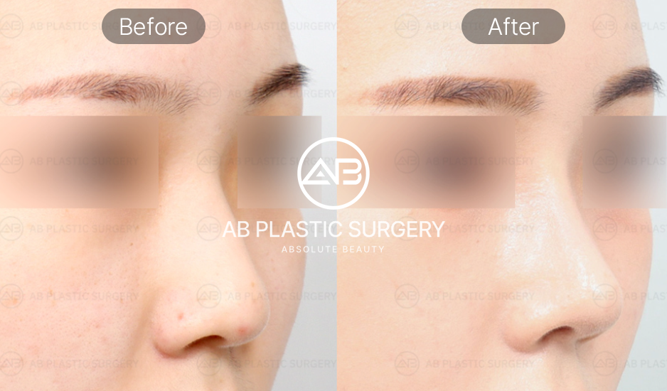 鼻整形 ビフォーアフター 斜めからの写真