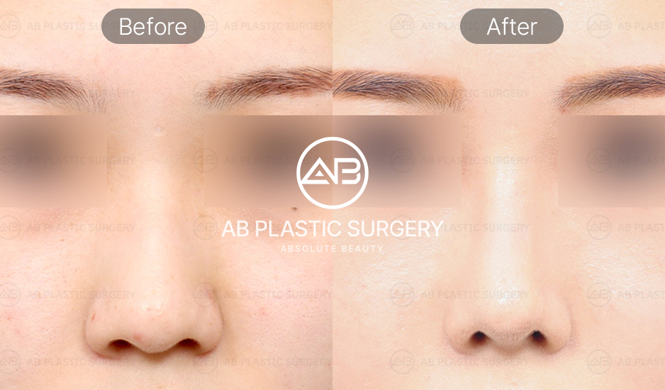 鼻整形 ビフォーアフター 正面写真