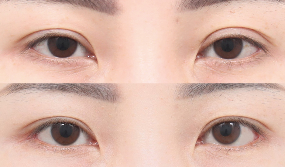 AB整形外科 目整形の施術結果写真