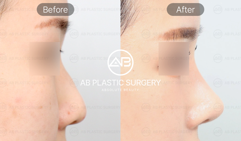 丸い鼻先をすっきりさせる方法