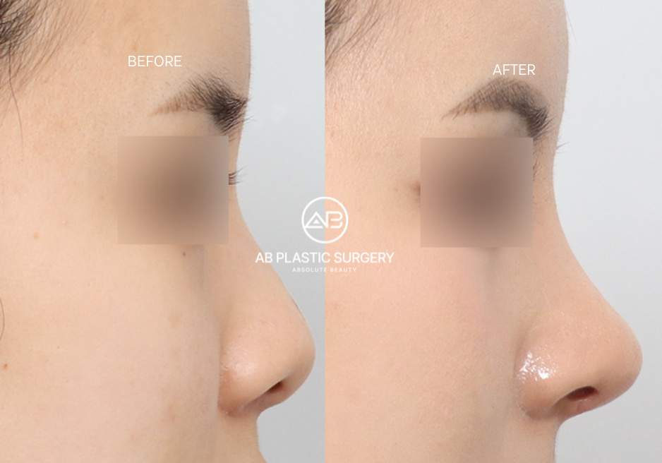 ABでのバービー鼻整形