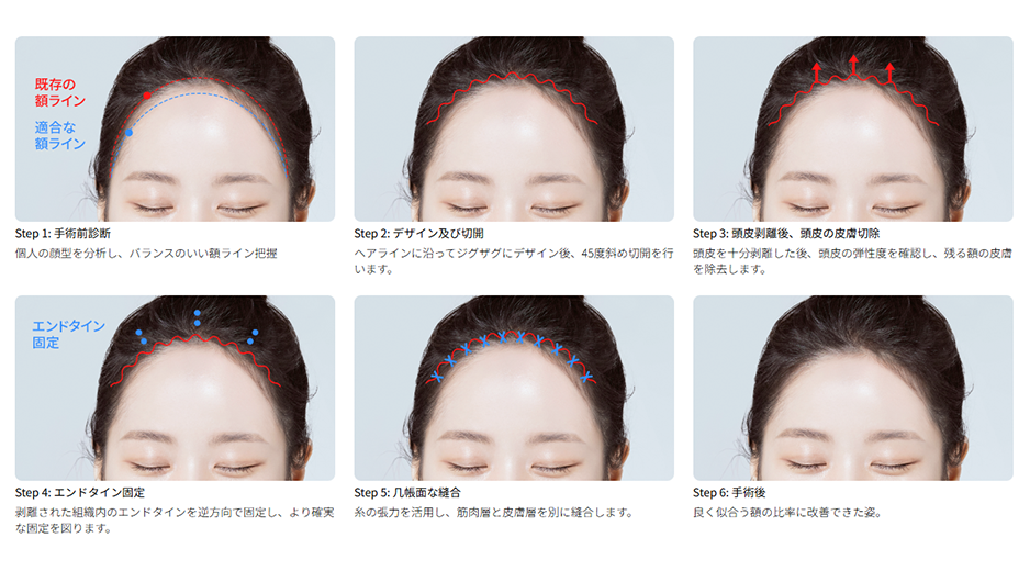 額縮小手術の6つのステップ