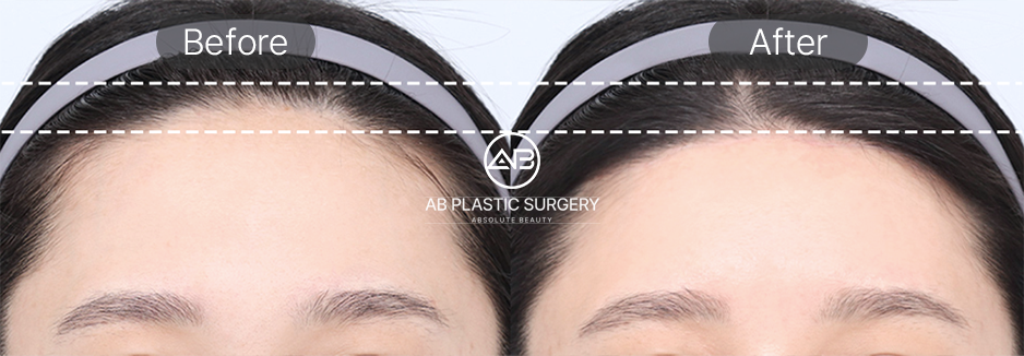 韓国額縮小手術ビフォーアフター写真