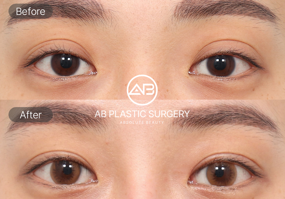 韓国の二重整形修正ビフォーアフター写真